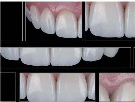 albarillo dental clinic|Replacing her old 9 Units direct composite Veneer with.